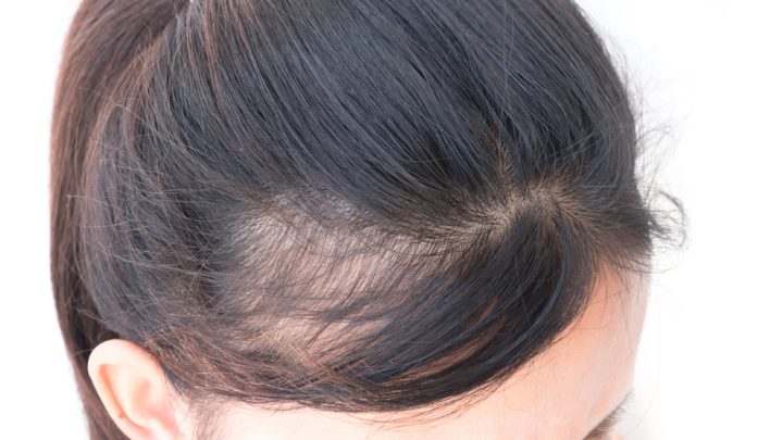 Coprire l’alopecia: quali prodotti usare