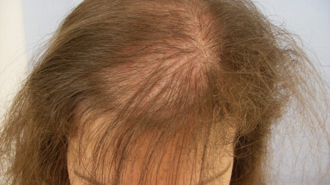 Ritrova i Tuoi Capelli! Soluzioni per l’Alopecia Femminile